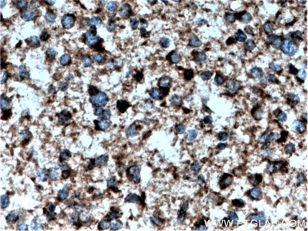 Immunohistochemistry (IHC) staining of human gliomas tissue using KIF3C Polyclonal antibody (14333-1-AP)