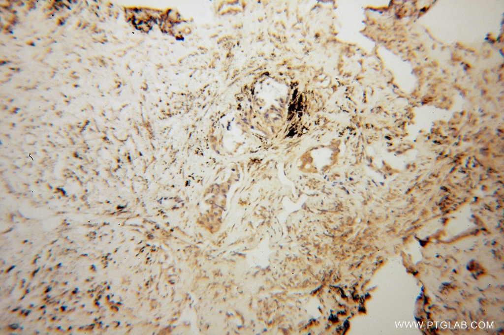 Immunohistochemistry (IHC) staining of human lung cancer tissue using KIF4A Polyclonal antibody (14344-1-AP)