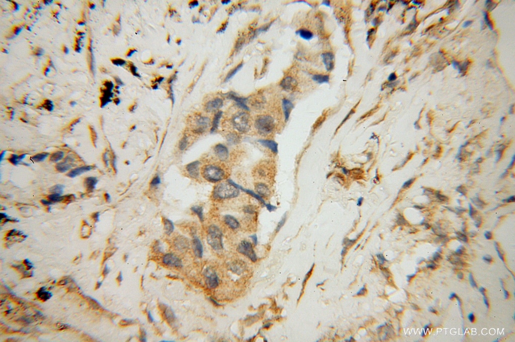 Immunohistochemistry (IHC) staining of human lung cancer tissue using KIF4A Polyclonal antibody (14344-1-AP)