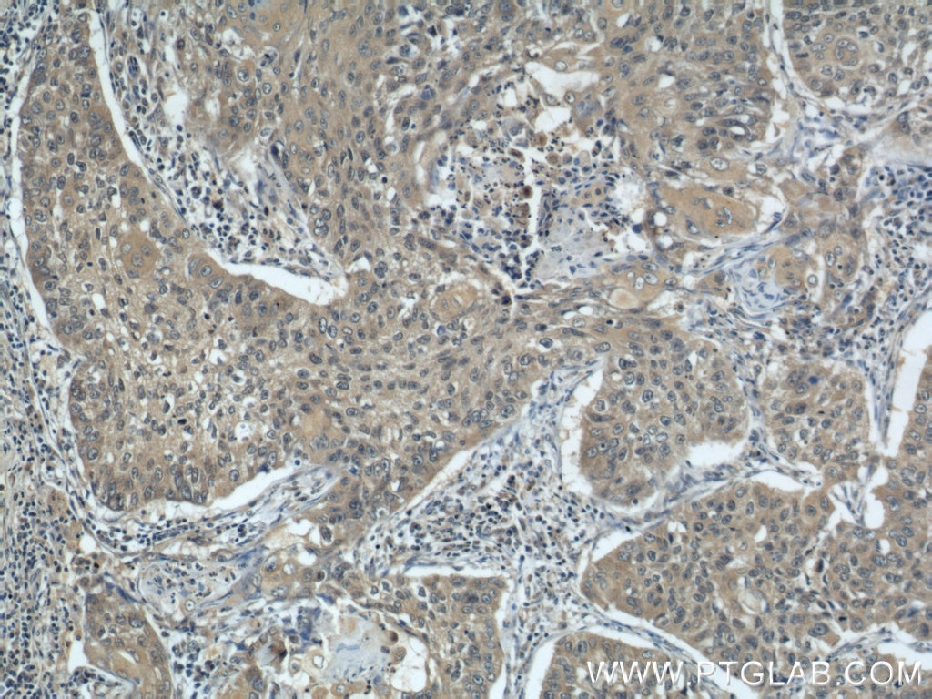 Immunohistochemistry (IHC) staining of human lung cancer tissue using KIF4A Polyclonal antibody (14344-1-AP)