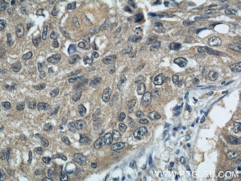 Immunohistochemistry (IHC) staining of human lung cancer tissue using KIF4A Polyclonal antibody (14344-1-AP)