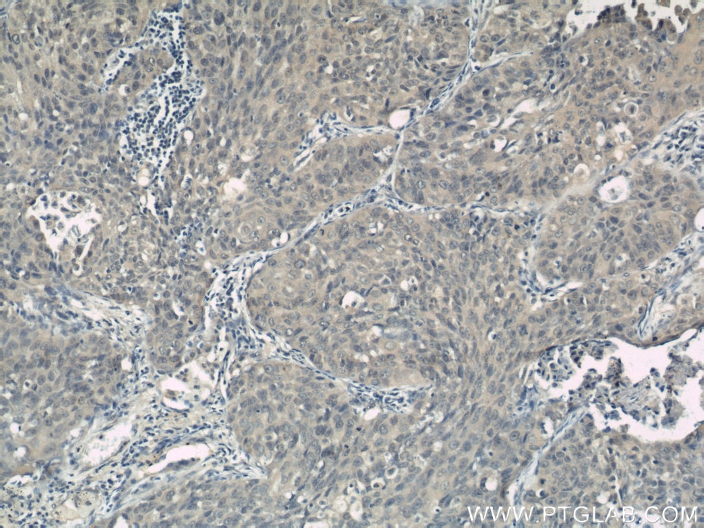 Immunohistochemistry (IHC) staining of human lung cancer tissue using KIF4A Polyclonal antibody (14344-1-AP)