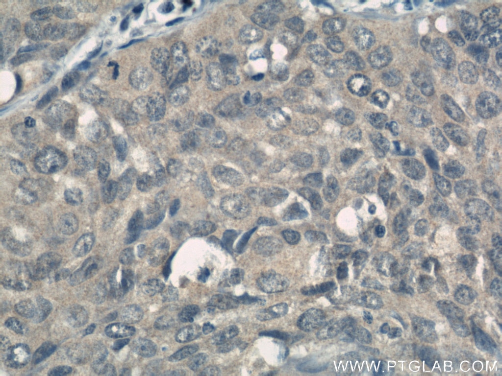 Immunohistochemistry (IHC) staining of human lung cancer tissue using KIF4A Polyclonal antibody (14344-1-AP)