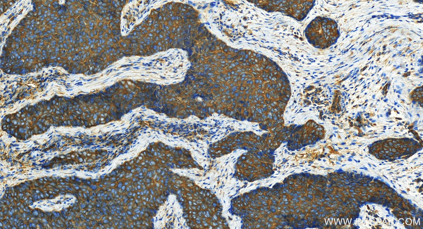 Immunohistochemical analysis of paraffin-embedded human bowen disease slide using 21632-1-AP (KIF5B antibody) at dilution of 1:1600 (under 20x lens). Heat mediated antigen retrieval with Tris-EDTA buffer (pH 9.0). Immunohistochemistry (IHC) staining of human bowen disease tissue using KIF5B Polyclonal antibody (21632-1-AP)