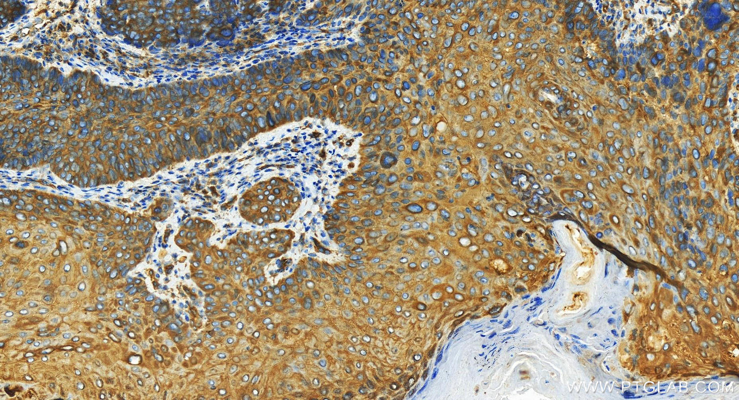 Immunohistochemical analysis of paraffin-embedded human bowen disease slide using 21632-1-AP (KIF5B antibody) at dilution of 1:1600 (under 20x lens). Heat mediated antigen retrieval with Tris-EDTA buffer (pH 9.0). Immunohistochemistry (IHC) staining of human bowen disease tissue using KIF5B Polyclonal antibody (21632-1-AP)