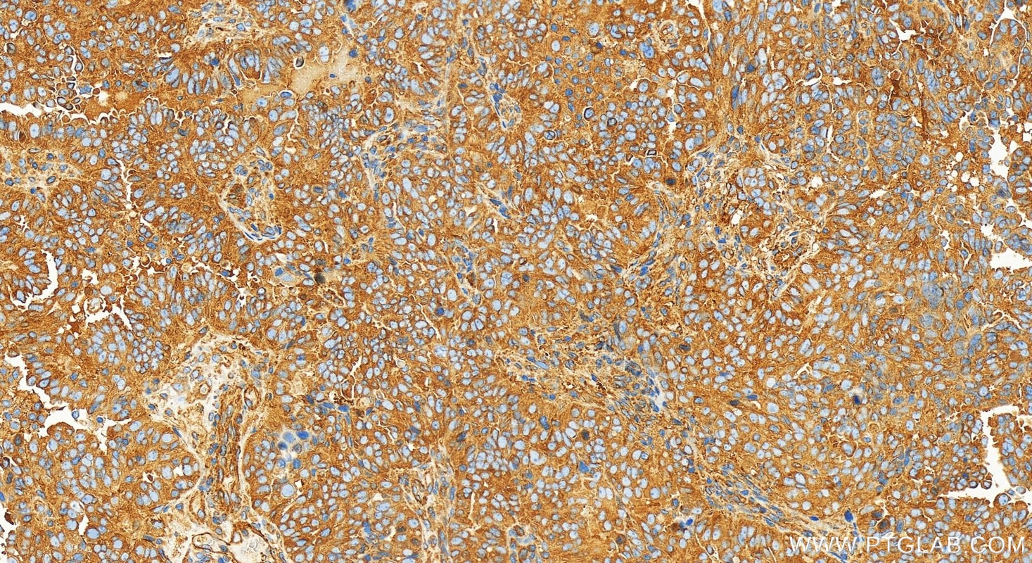 Immunohistochemistry (IHC) staining of human ovarian  cancer using KIF5B Recombinant antibody (82485-1-RR)