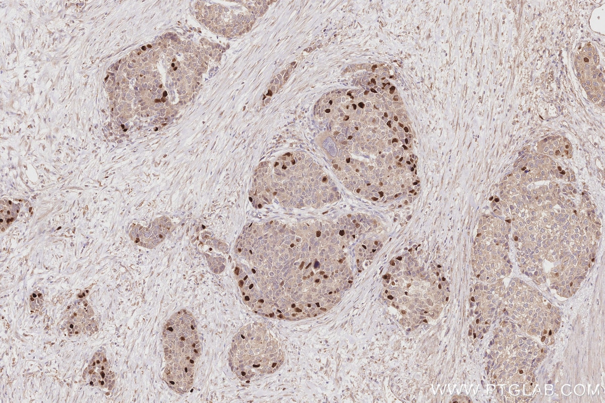 Immunohistochemistry (IHC) staining of human stomach cancer tissue using KIFC1 Polyclonal antibody (20790-1-AP)