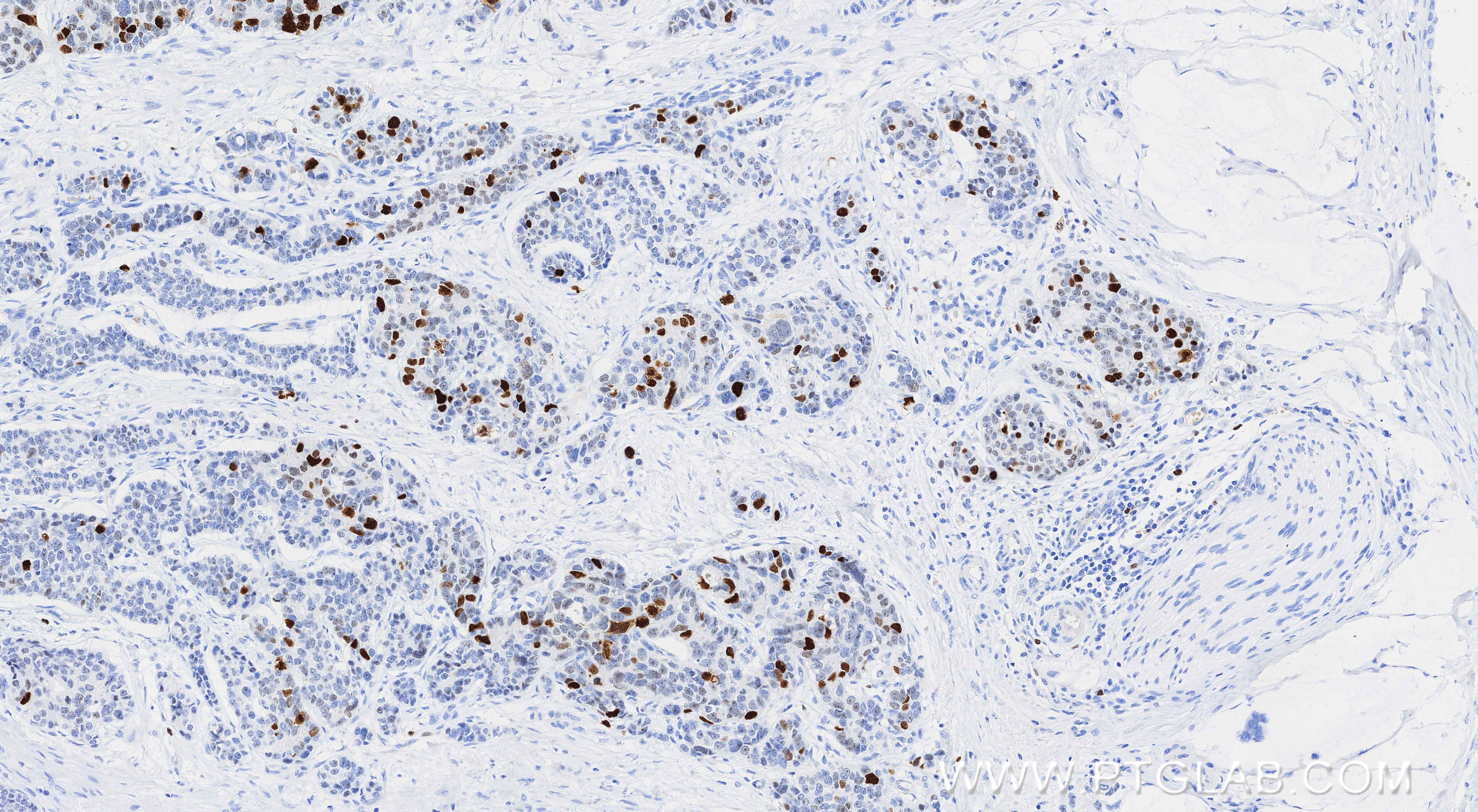 Immunohistochemistry (IHC) staining of human stomach cancer tissue using KIFC1 Recombinant monoclonal antibody (85981-1-RR)