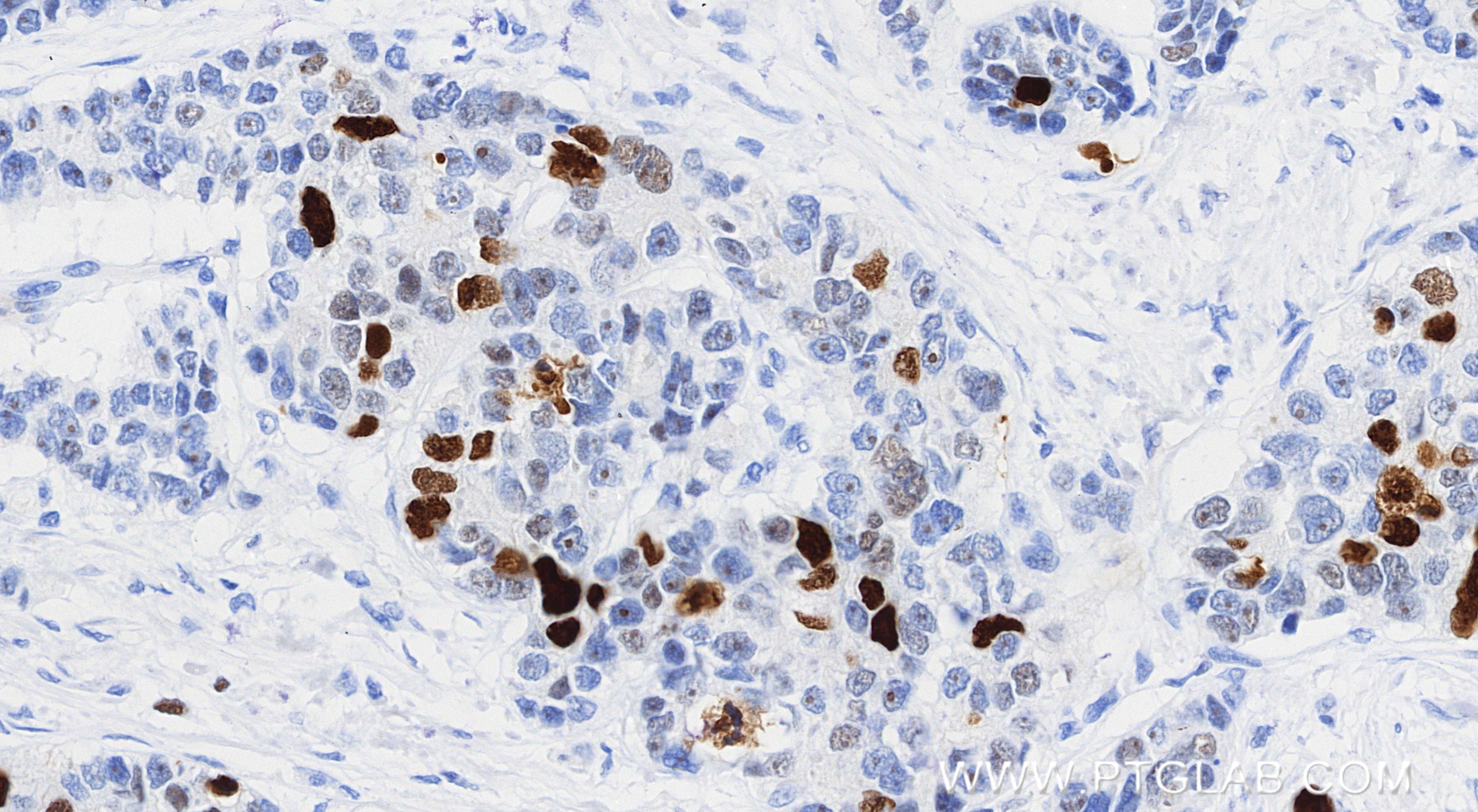 Immunohistochemistry (IHC) staining of human stomach cancer tissue using KIFC1 Recombinant monoclonal antibody (85981-1-RR)