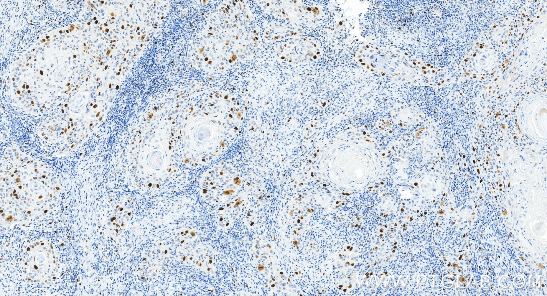 Immunohistochemistry (IHC) staining of human skin cancer tissue using KIFC1 Recombinant monoclonal antibody (85981-1-RR)
