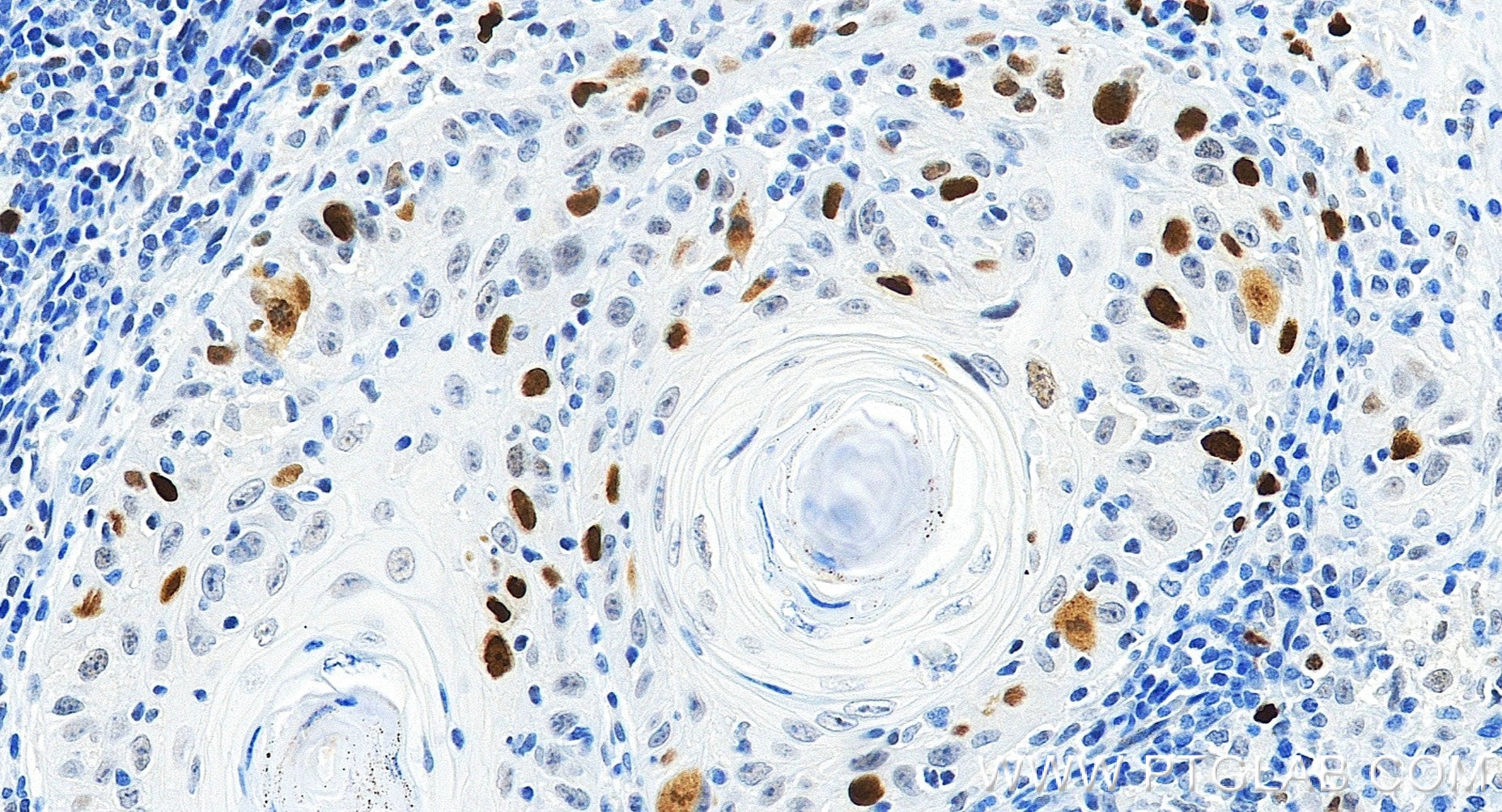 Immunohistochemistry (IHC) staining of human skin cancer tissue using KIFC1 Recombinant monoclonal antibody (85981-1-RR)