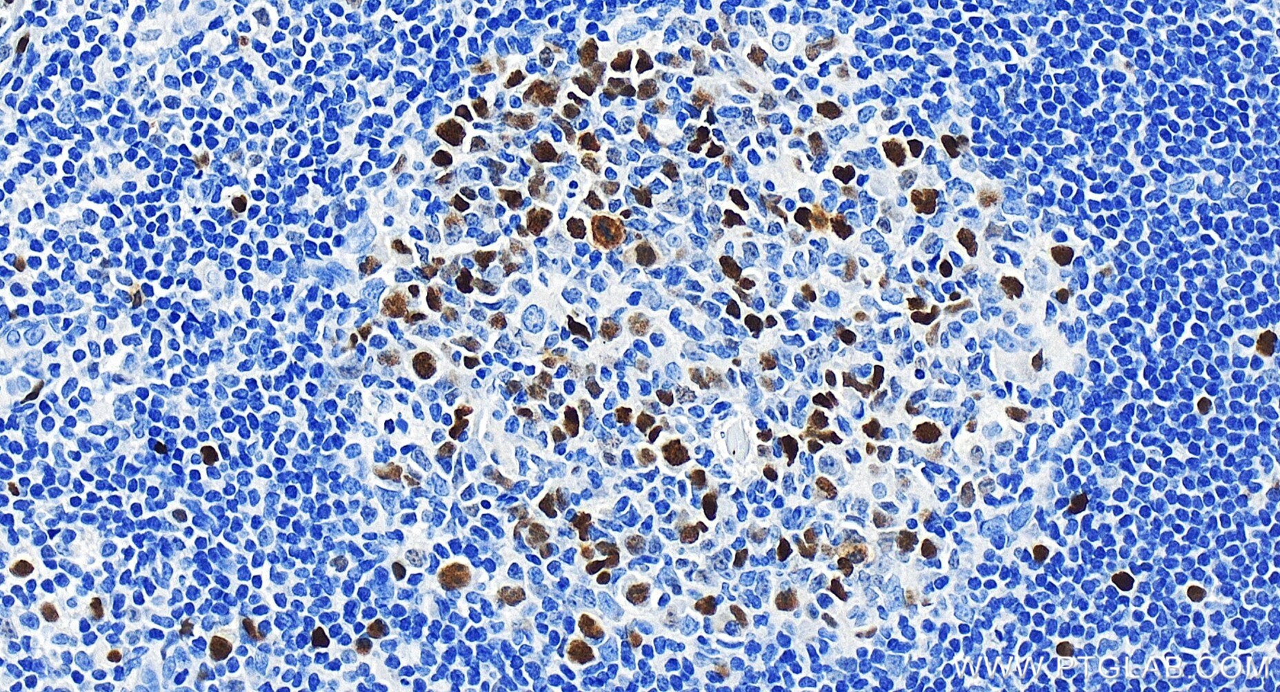 Immunohistochemistry (IHC) staining of human tonsillitis tissue using KIFC1 Recombinant antibody (85981-1-RR)