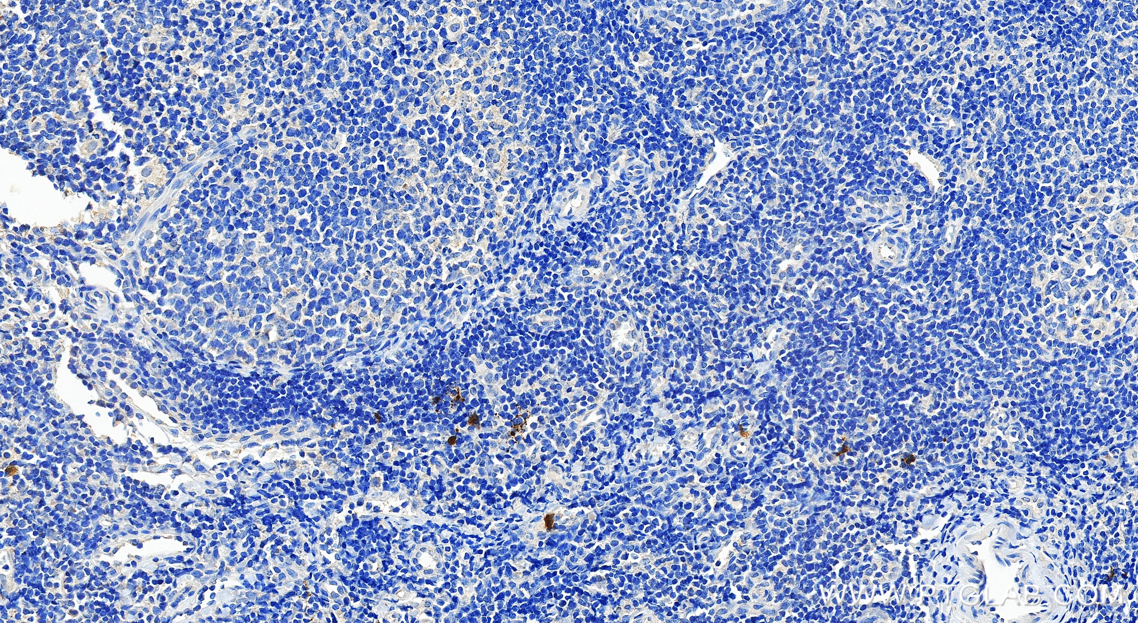 IHC staining of human tonsillitis using 85168-2-RR Immunohistochemistry (IHC) staining of human tonsillitis tissue using KIR2DL1 Recombinant monoclonal antibody (85168-2-RR)