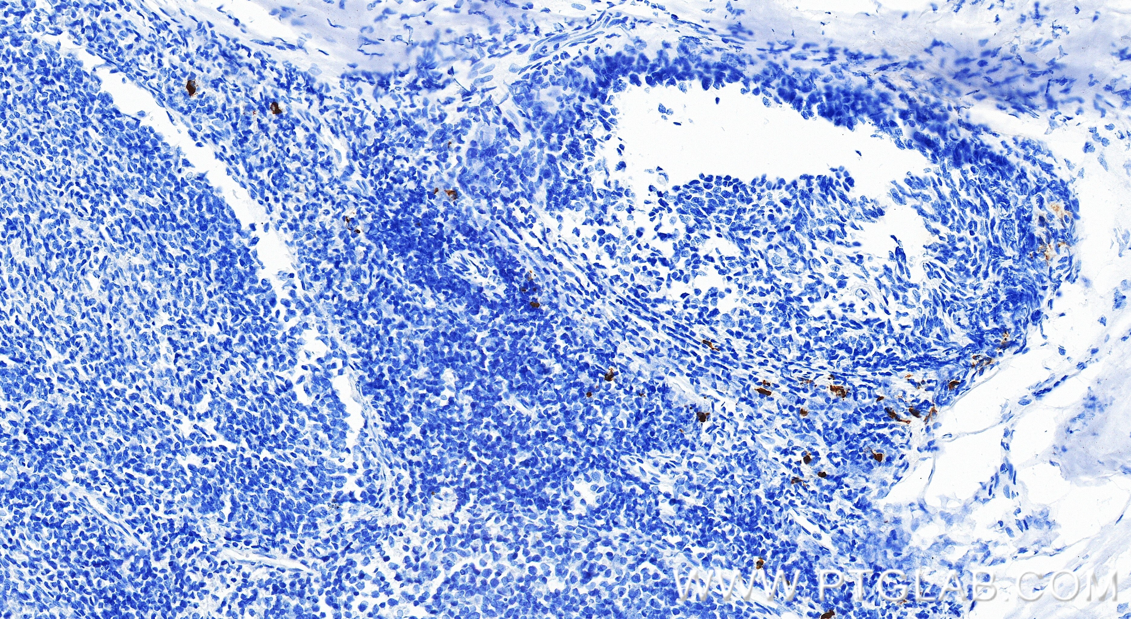 Immunohistochemistry (IHC) staining of human tonsillitis tissue using Anti-Human KIR2DL3/CD158b2 Rabbit Recombinant Anti (98373-3-RR)