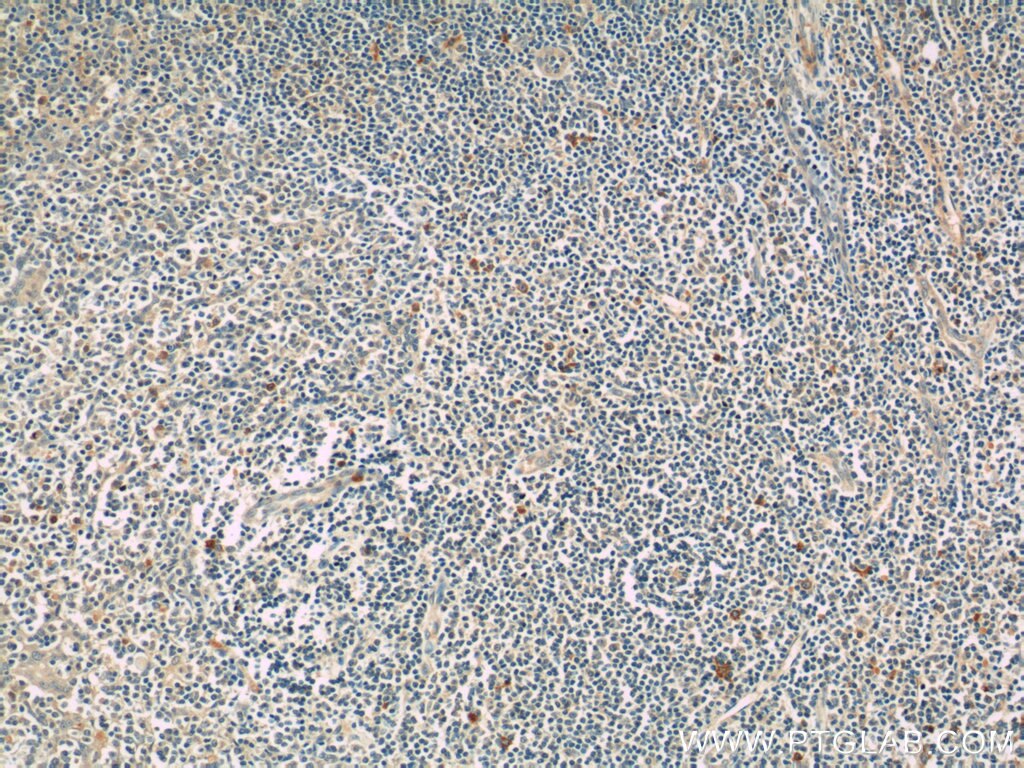 IHC staining of human tonsillitis using 17583-1-AP