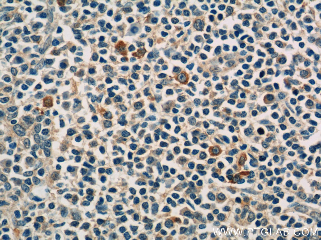 Immunohistochemistry (IHC) staining of human tonsillitis tissue using KIR3DX1 Polyclonal antibody (17583-1-AP)