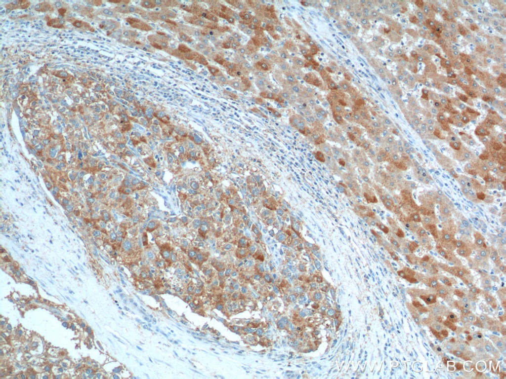 Immunohistochemistry (IHC) staining of human liver cancer tissue using KISS1 Polyclonal antibody (18375-1-AP)