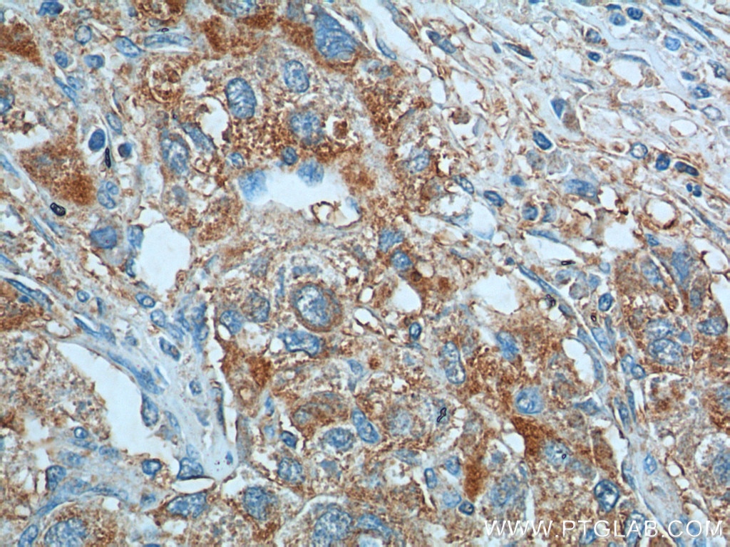 Immunohistochemistry (IHC) staining of human liver cancer tissue using KISS1 Polyclonal antibody (18375-1-AP)