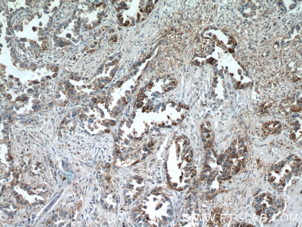 IHC staining of human lung cancer using 18375-1-AP