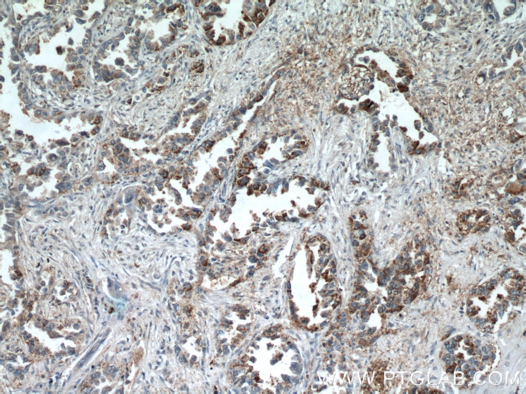 Immunohistochemistry (IHC) staining of human lung cancer tissue using KISS1 Polyclonal antibody (18375-1-AP)