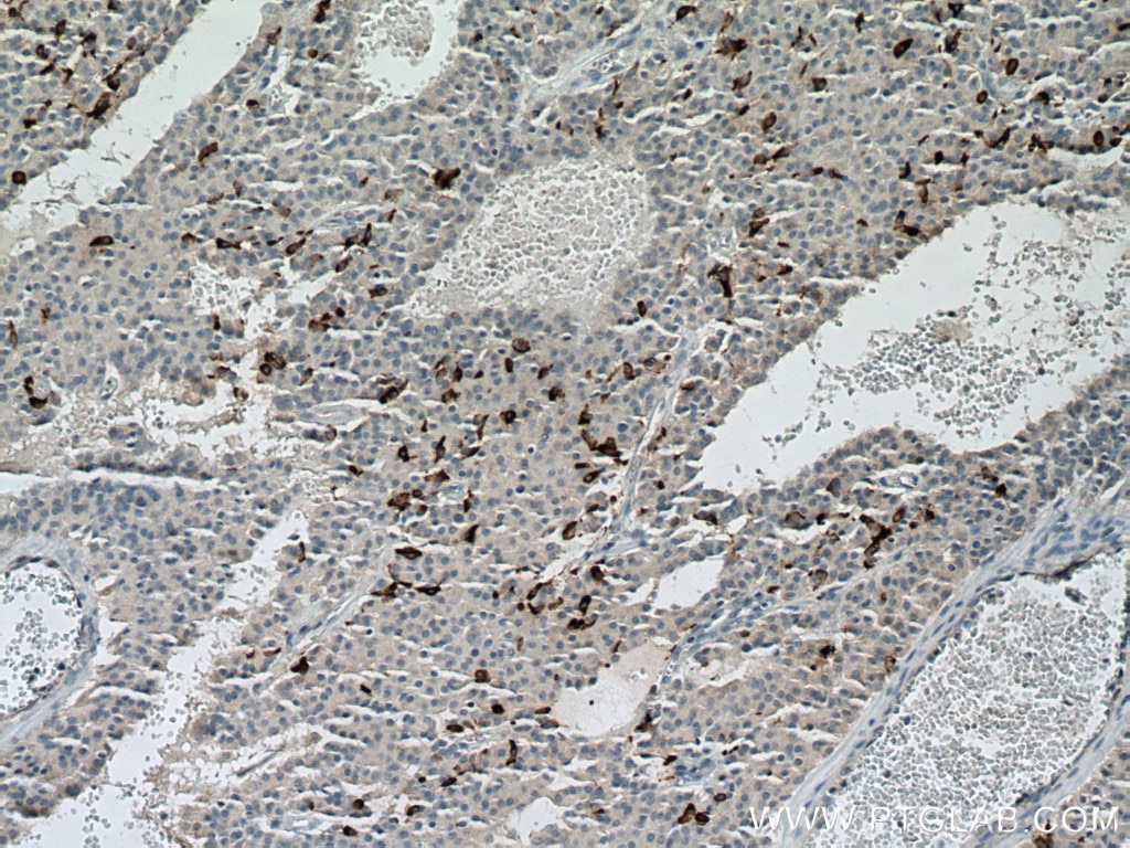 Immunohistochemistry (IHC) staining of Insulinoma tissue using c-Kit/CD117 Polyclonal antibody (18696-1-AP)