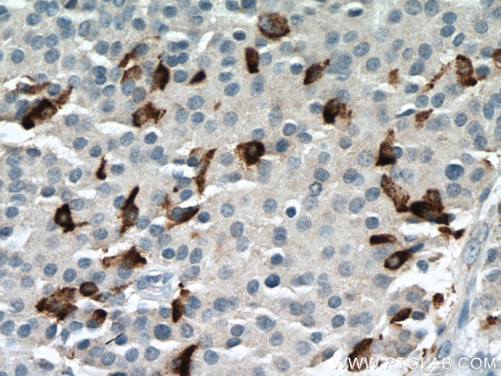 Immunohistochemistry (IHC) staining of Insulinoma tissue using c-Kit/CD117 Polyclonal antibody (18696-1-AP)