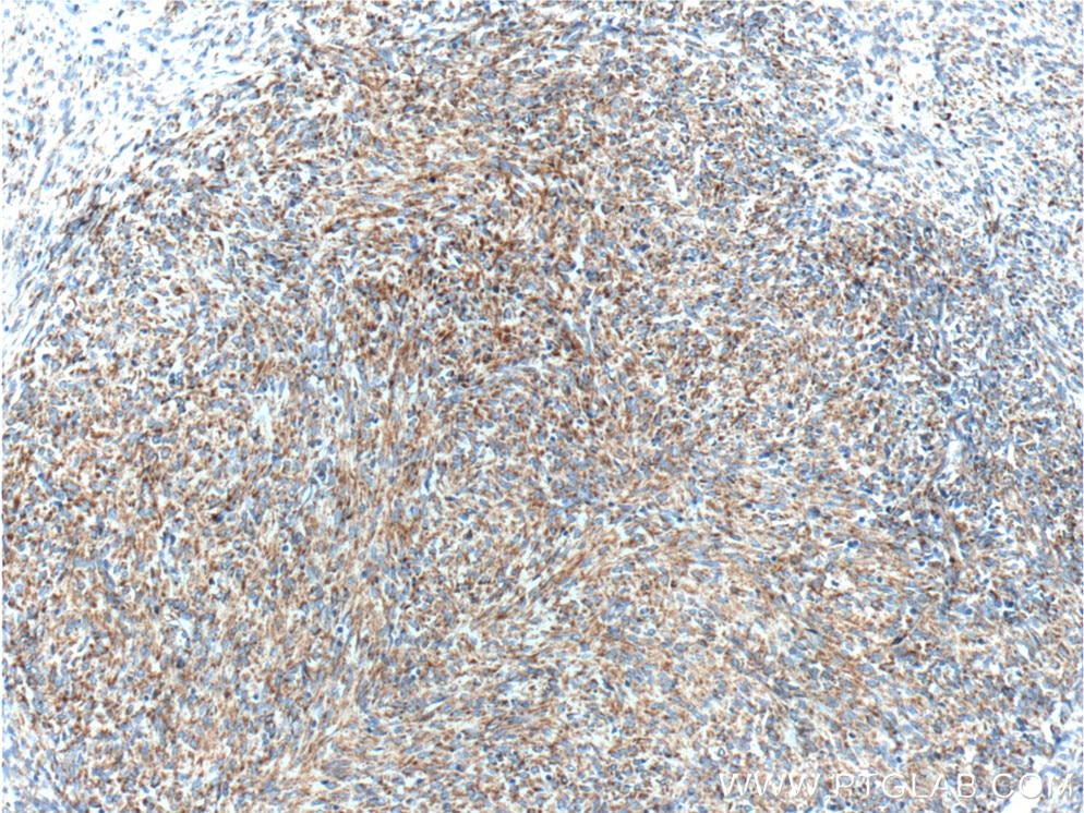 Immunohistochemistry (IHC) staining of stromal tumor tissue using c-Kit/CD117 Polyclonal antibody (18696-1-AP)