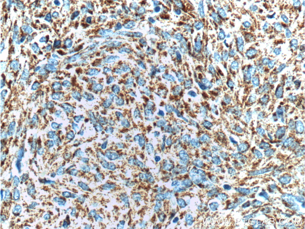Immunohistochemistry (IHC) staining of stromal tumor tissue using c-Kit/CD117 Polyclonal antibody (18696-1-AP)