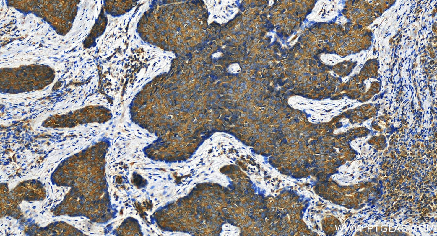 Immunohistochemistry (IHC) staining of human bowen disease using KLC1 Polyclonal antibody (19028-1-AP)