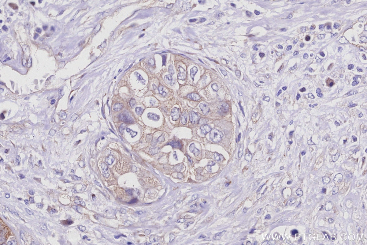 IHC staining of human pancreas cancer using 16493-1-AP Immunohistochemistry (IHC) staining of human pancreas cancer tissue using KLC4 Polyclonal antibody (16493-1-AP)