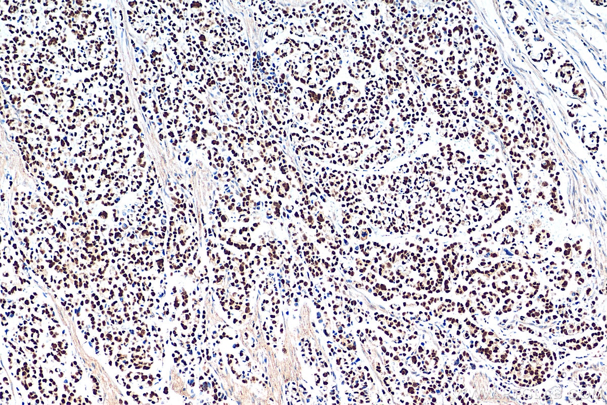 IHC staining of human colon cancer using 21017-1-AP