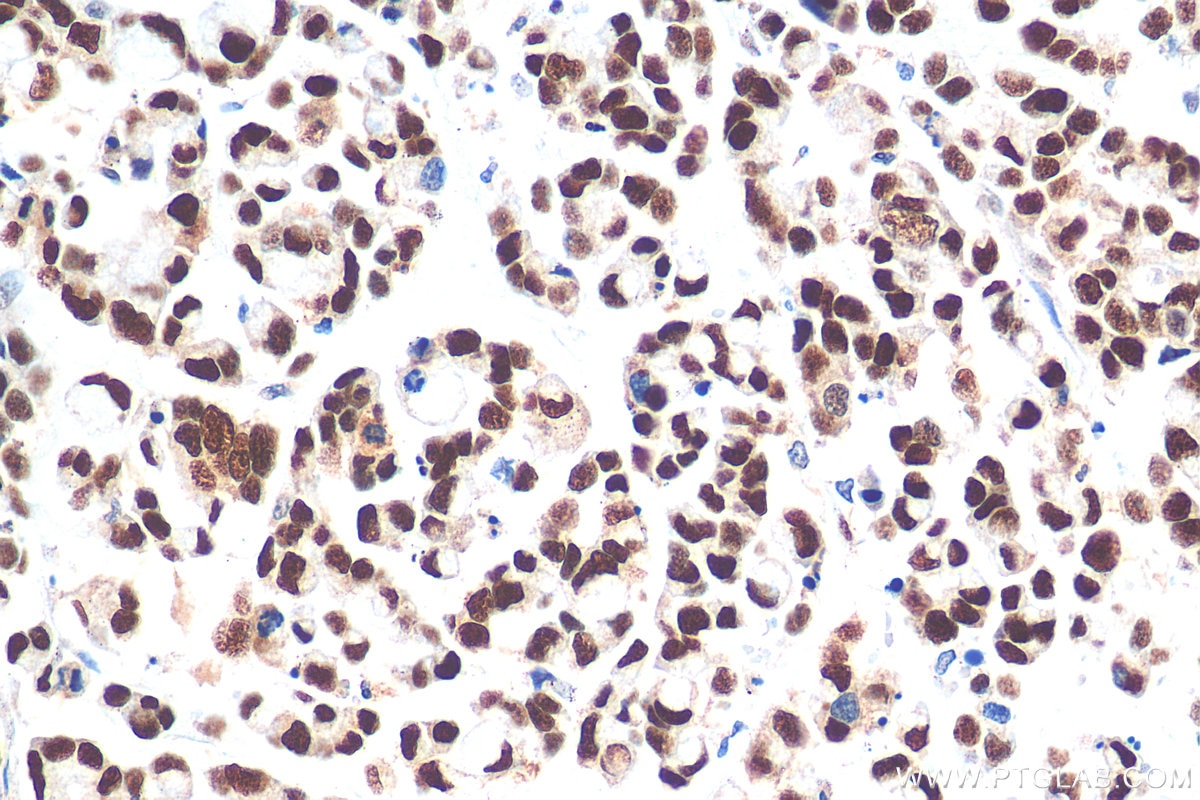 Immunohistochemistry (IHC) staining of human colon cancer tissue using KLF5 Polyclonal antibody (21017-1-AP)