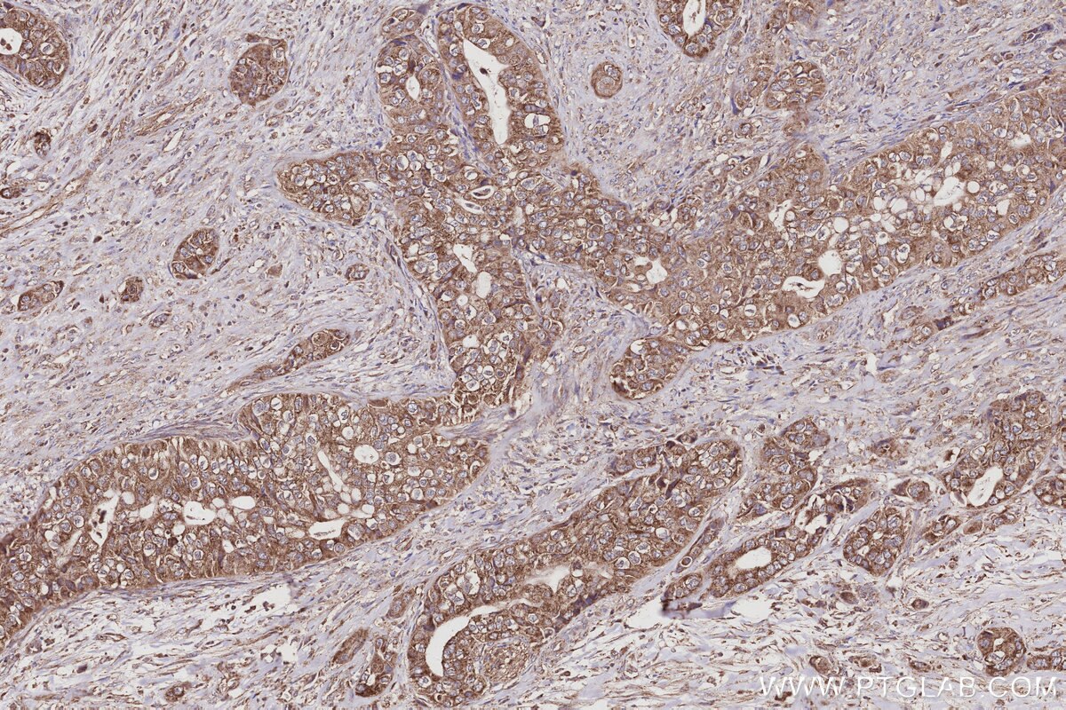 Immunohistochemistry (IHC) staining of human pancreas cancer tissue using KLHDC5 Polyclonal antibody (24847-1-AP)