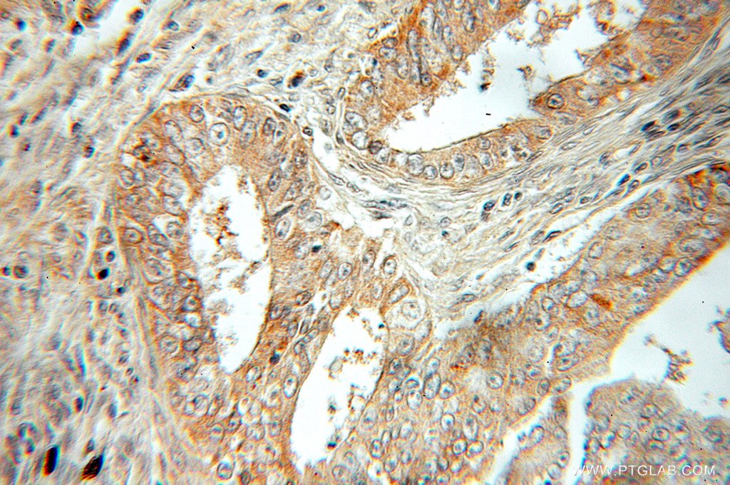 Immunohistochemistry (IHC) staining of human ovary tumor tissue using KLHL14 Polyclonal antibody (51131-1-AP)