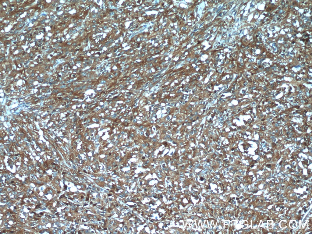 Immunohistochemistry (IHC) staining of human cervical cancer tissue using KLHL14-Specific Polyclonal antibody (14849-1-AP)