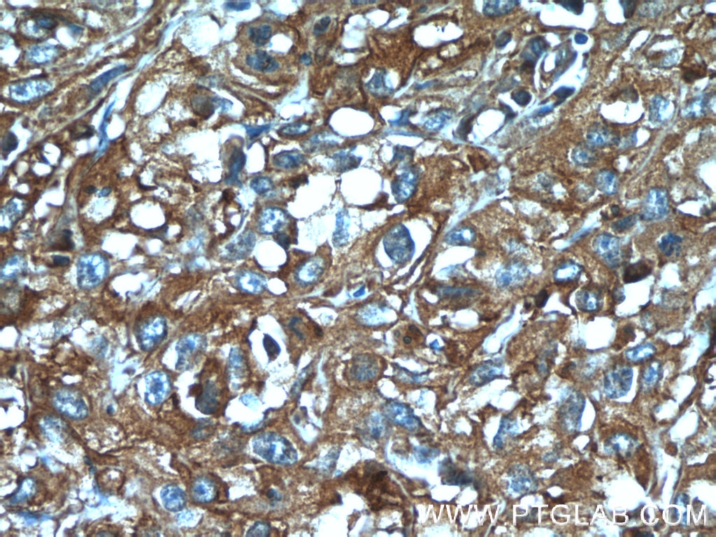Immunohistochemistry (IHC) staining of human cervical cancer tissue using KLHL14-Specific Polyclonal antibody (14849-1-AP)