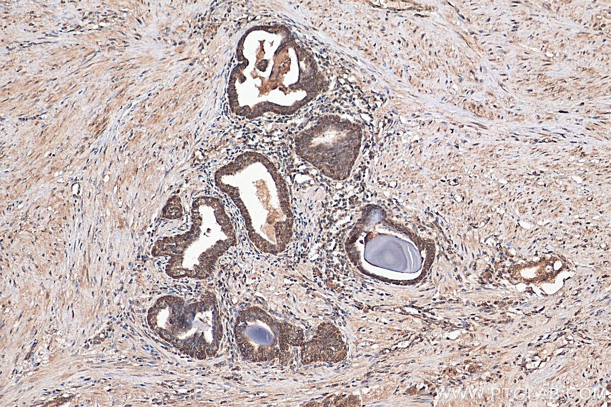 Immunohistochemistry (IHC) staining of human prostate cancer tissue using KLHL15 Polyclonal antibody (25066-1-AP)