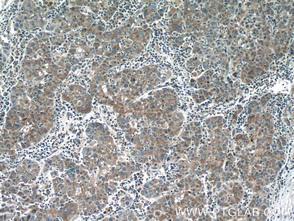 Immunohistochemistry (IHC) staining of human liver cancer tissue using KLHL21 Polyclonal antibody (16952-1-AP)