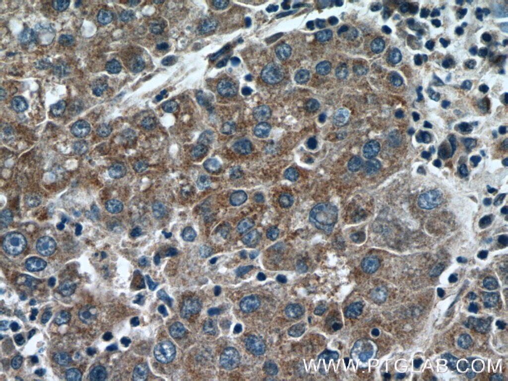 Immunohistochemistry (IHC) staining of human liver cancer tissue using KLHL21 Polyclonal antibody (16952-1-AP)