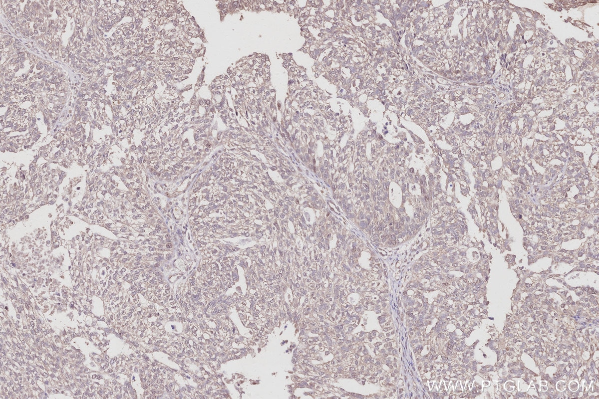 Immunohistochemistry (IHC) staining of human ovary cancer tissue using KLHL21 Polyclonal antibody (16952-1-AP)