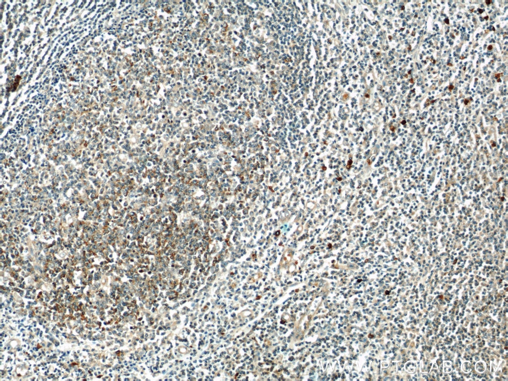 Immunohistochemistry (IHC) staining of human tonsillitis tissue using KLHL3 Polyclonal antibody (16951-1-AP)