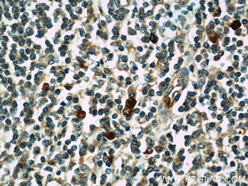 Immunohistochemistry (IHC) staining of human tonsillitis tissue using KLHL3 Polyclonal antibody (16951-1-AP)