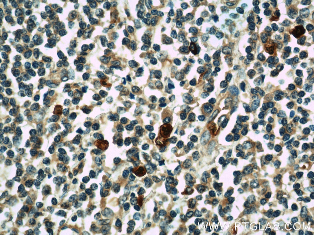 IHC staining of human tonsillitis using 16951-1-AP