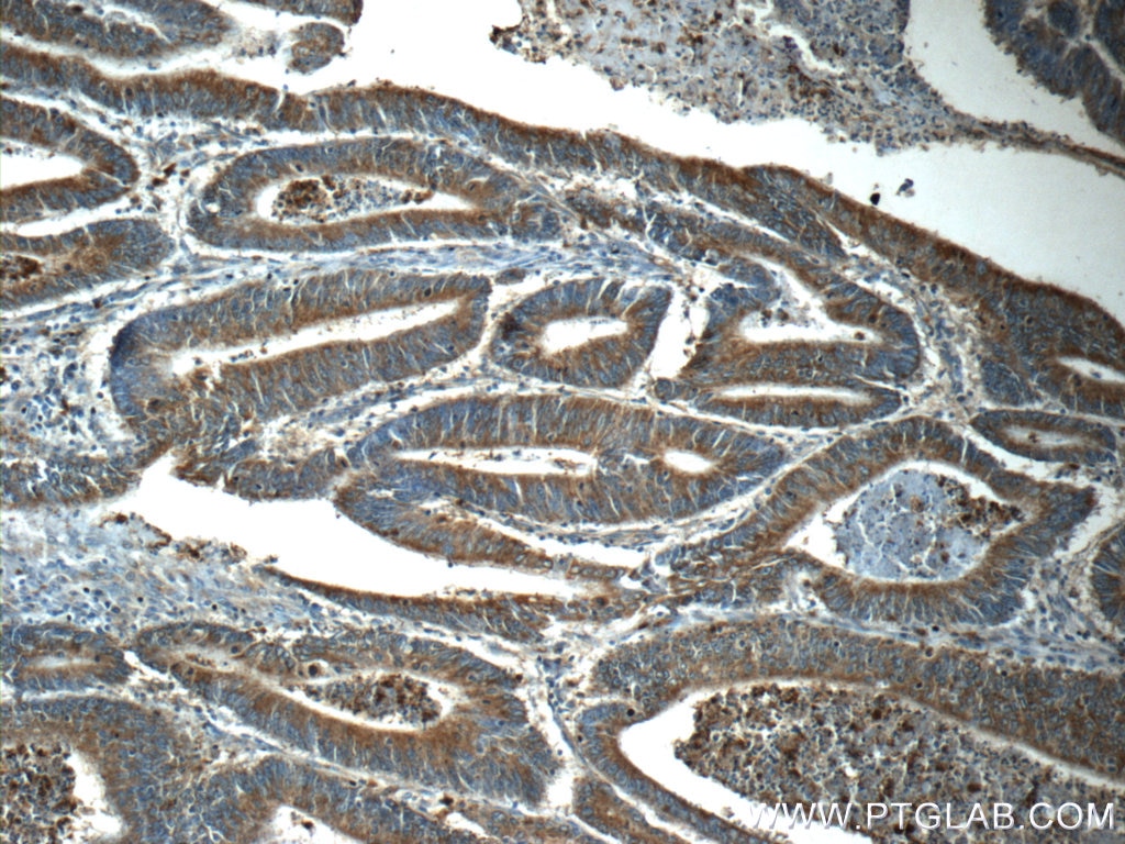 Immunohistochemistry (IHC) staining of human colon cancer tissue using KLHL31 Polyclonal antibody (24781-1-AP)