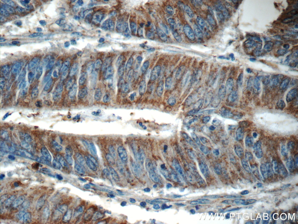 Immunohistochemistry (IHC) staining of human colon cancer tissue using KLHL31 Polyclonal antibody (24781-1-AP)