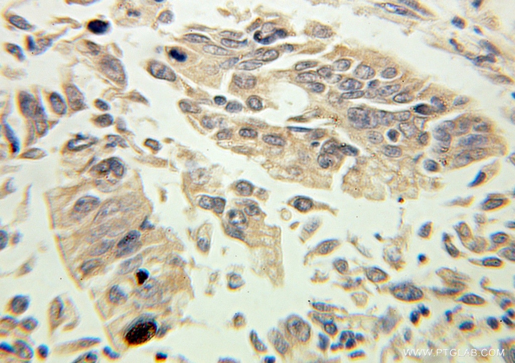 Immunohistochemistry (IHC) staining of human pancreas cancer tissue using Kallikrein 1 Polyclonal antibody (10815-1-AP)