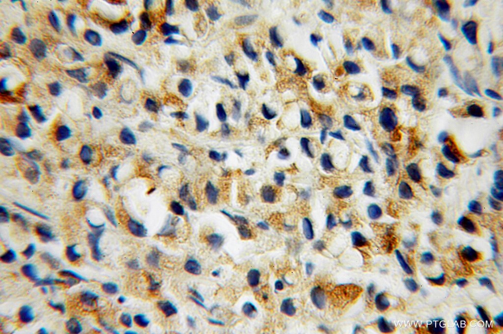 Immunohistochemistry (IHC) staining of human prostate cancer tissue using Kallikrein 11 Polyclonal antibody (12698-1-AP)