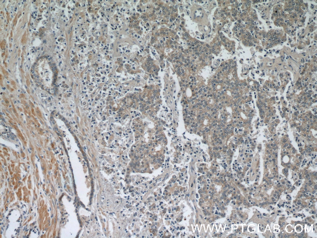 Immunohistochemistry (IHC) staining of human prostate cancer tissue using Kallikrein 11 Polyclonal antibody (12698-1-AP)