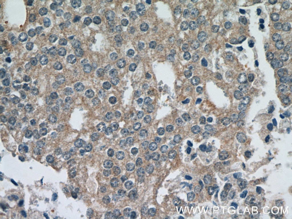 IHC staining of human prostate cancer using 12698-1-AP