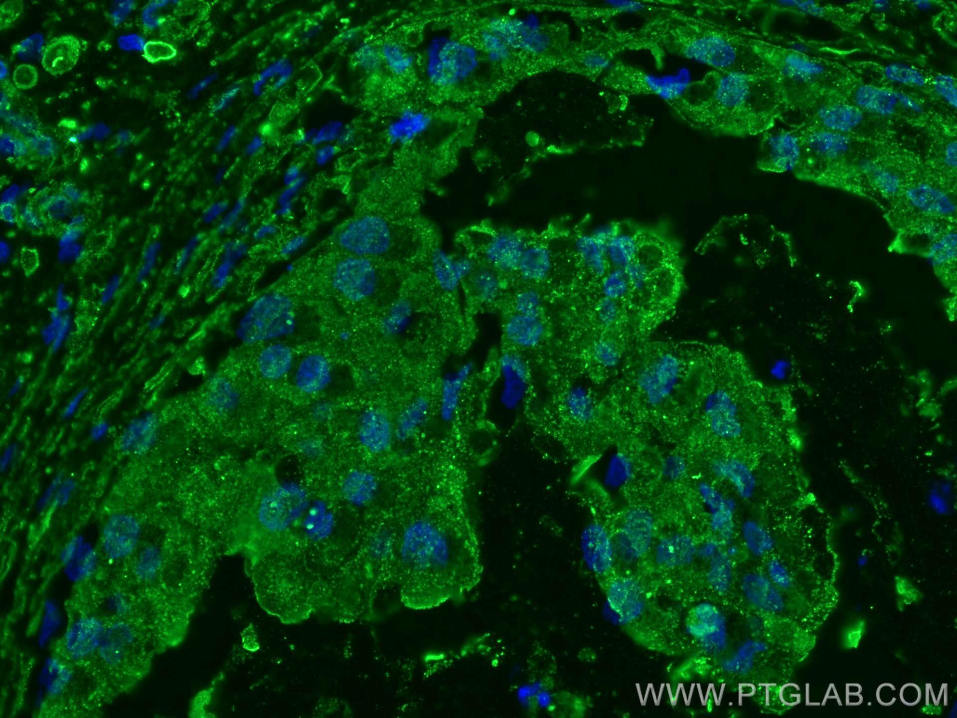 Immunofluorescence (IF) / fluorescent staining of human breast cancer tissue using KLK11 Monoclonal antibody (67427-1-Ig)